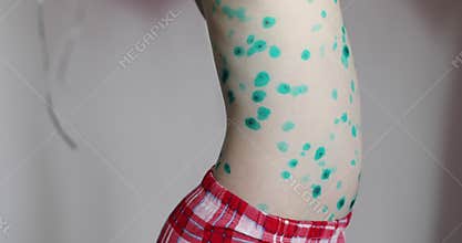 Varicella. A girl is with chickenpox.