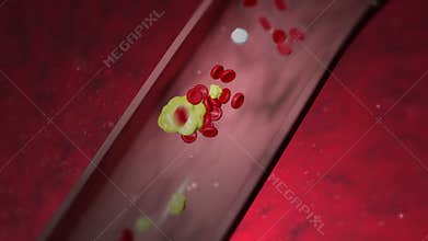 Heart attack overview