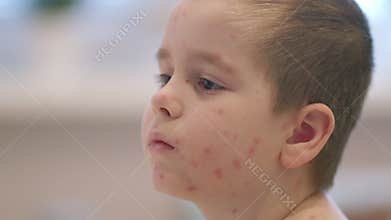 A closeup of a child with a distinct skin condition chickenpox, showcasing their unique beauty