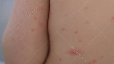 Concerns about skin condition chickenpox presenting as red spots on a childs back need attention