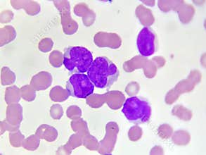 Acute myeloid leukemia