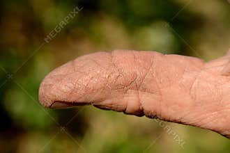 Cracked skin on a workman's hand