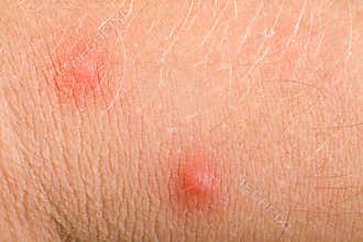 Pimples on skin