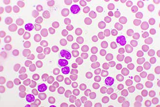 Picture of acute lymphocytic leukemia or ALL cells in blood smear