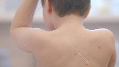 A child presenting with noticeable skin irritation chickenpox, featuring visible red bumps on their skin