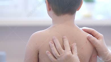 A child with a skin condition back view of their skin chickenpox, showing symptoms and details