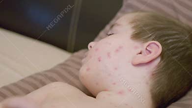 A Child with an Acne Skin Condition chickenpox Lying Down Comfortably on a Pillow in the Bedroom