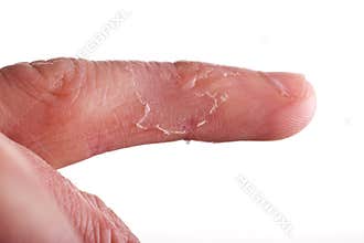 Eczema on finger