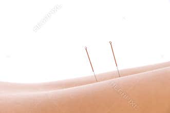Acupuncture