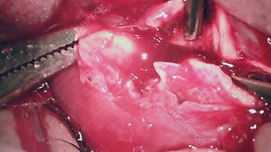 Macro Image of Eyes During Eye Surgery. Creepy Ophthalmological surgery.