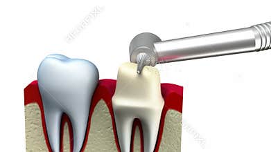 Dental crown installation process
