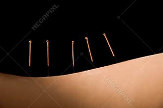 Acupuncture