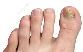 Toenail Fungus at Peak Infection