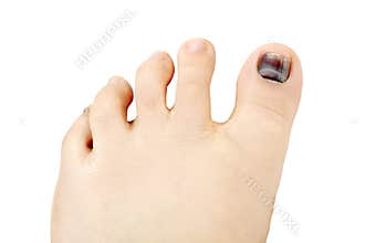 Subungual hematoma blue and black toe nail