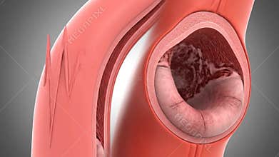 Colon Polyp Growth Animation on Gray Medical Background Illustrates Intestinal Disease for Health Awareness Campaign