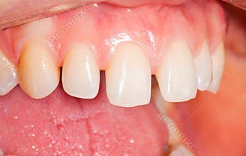 Tooth spaces