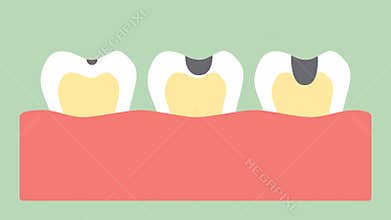 Stages of tooth decay or dental caries