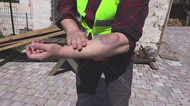 Worker with arm injury