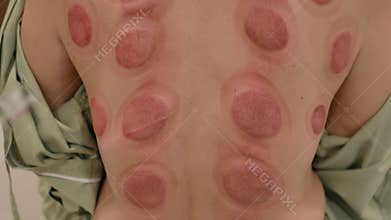 Cupping treatment in alternative medical hospital