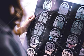 MRI brain Dementia