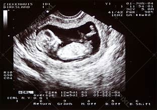 New Life, 2D echo