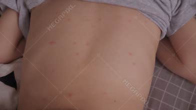 The child has a lot of blisters and smallpox from chickenpox on the skin.