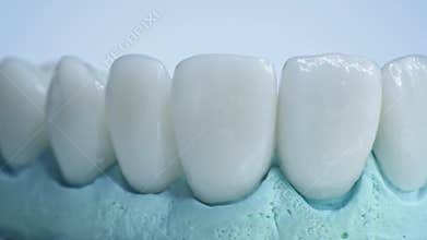 Panoramic close up view of dental implants in jaw with blue background. New white teeth are on a table in lab