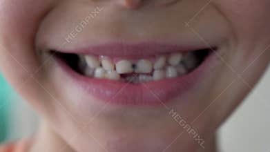 Close up little child show broken teeth boy with a Teeth broken and caries