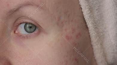 woman with post acne scars