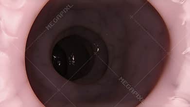 Colon polyps