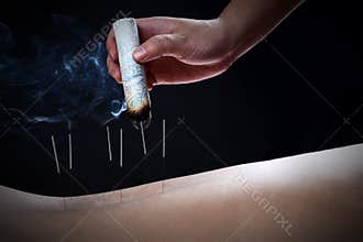 Acupuncture and moxibustion--a traditional chinese medicine method