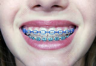 Pretty Smile with Braces