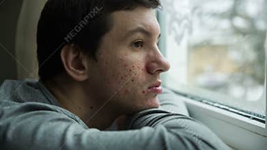 Acne on a face of a man