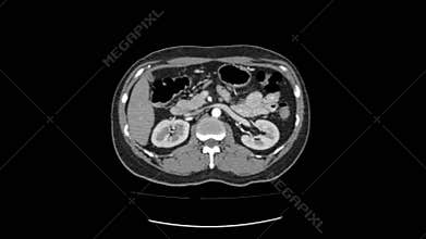 Ct scan of upper abdomen top view