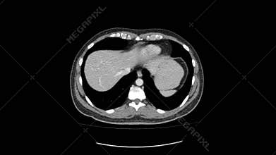 Ct scan of upper abdomen top view