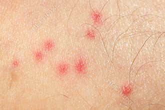 Mosquito bites
