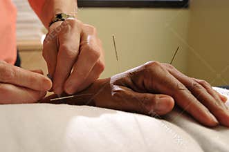 Acupuncture needles
