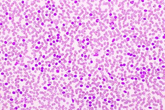 Acute lymphocytic leukemia or ALL cells