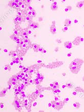 Acute lymphocytic leukemia or ALL cells