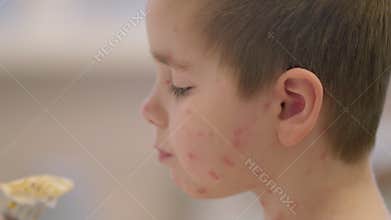 A child with a skin condition chickenpox, illuminated in natural light, showcasing their beauty and innocence