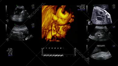 Diagnosis of Pregnancy