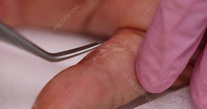 Doctor removes peeling skin from patient finger