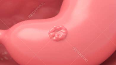Stomach Polyp Growth Close-up on Pink Organ Surface Demonstrating Medical Anomaly Growth Visualization Anatomy and