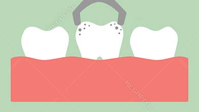 Tooth extraction by dental tools, removal decay tooth