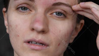 Beautiful girl with not smooth skin crushes acne on her face