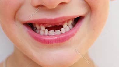 The smile of a child who has lost a baby tooth. Care for children`s teeth.