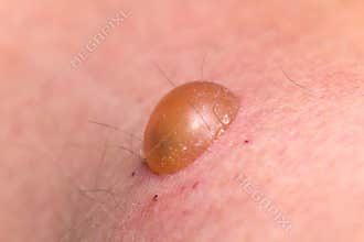 Blister Wound on the Skin