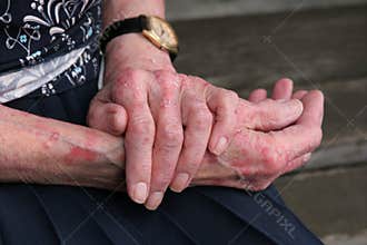 Sceriosis Skin Disease