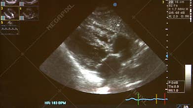 Ultrasound scan of human heart