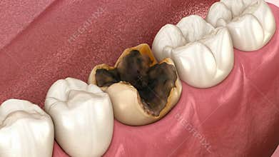 Molar teeth damaged by caries. Medically accurate tooth animation